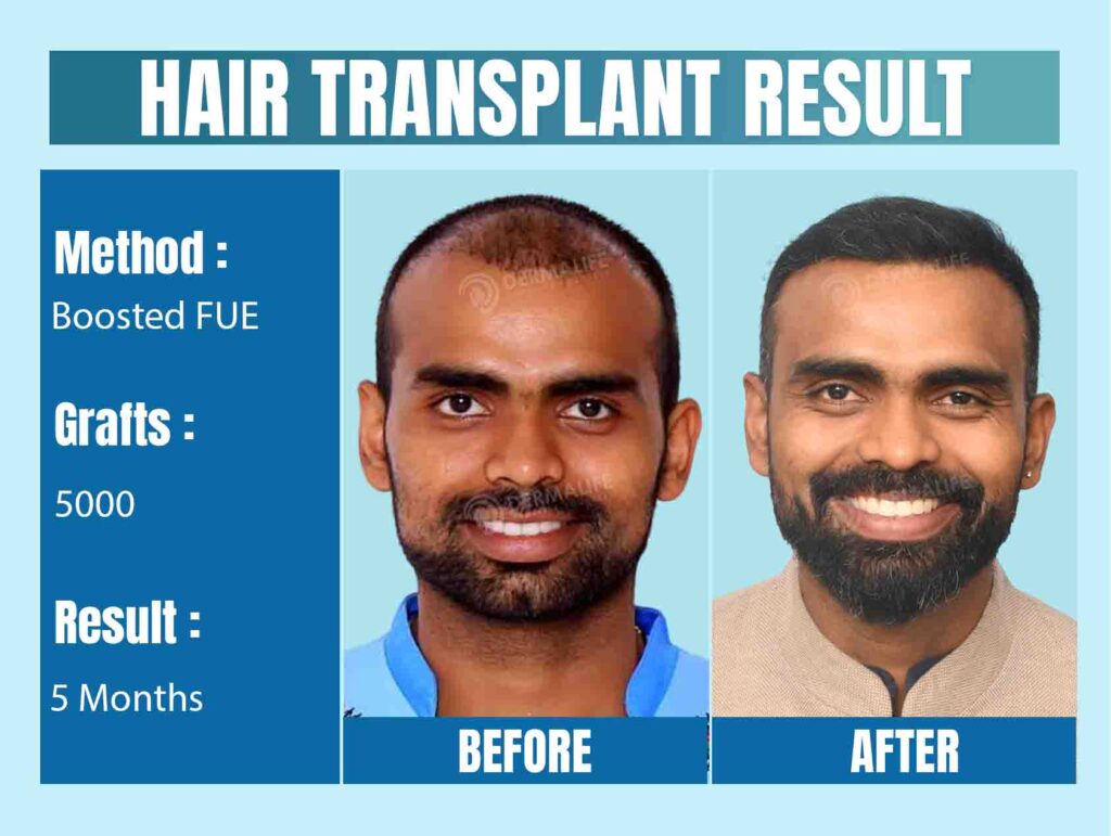 Hair Transplant in Delhi: Side Effects You Should Know