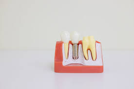 Dental Implants Trial: What You Need to Know Before Committing Dental Implants Trial: What You Need to Know Before Committing